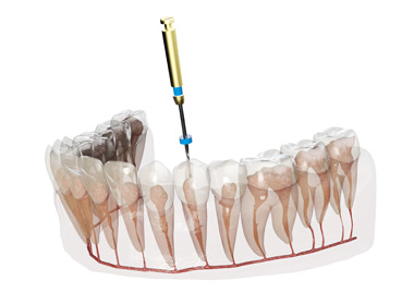 根管治療は進行した重度の虫歯を残すための処置です