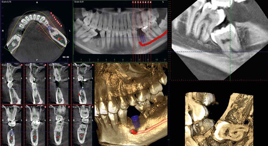 歯科用CTによる精確な診査診断